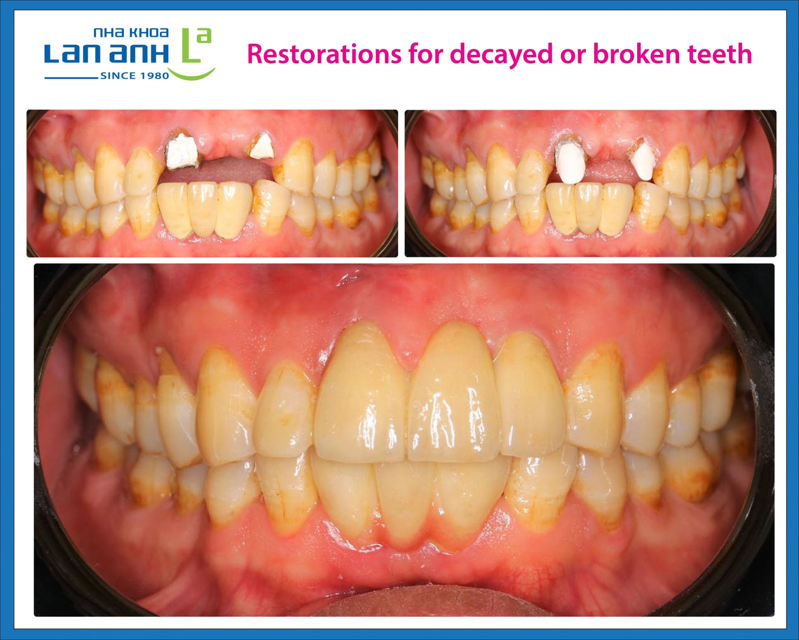 Restorations for decayed and broken teeth